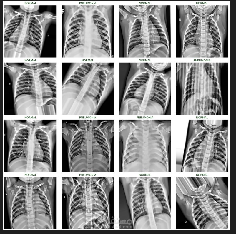 Chest X-Ray Classification