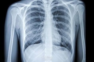 التعرف على ال (Pneumonia) -مرض رئوي- من خلال صور الاشعة