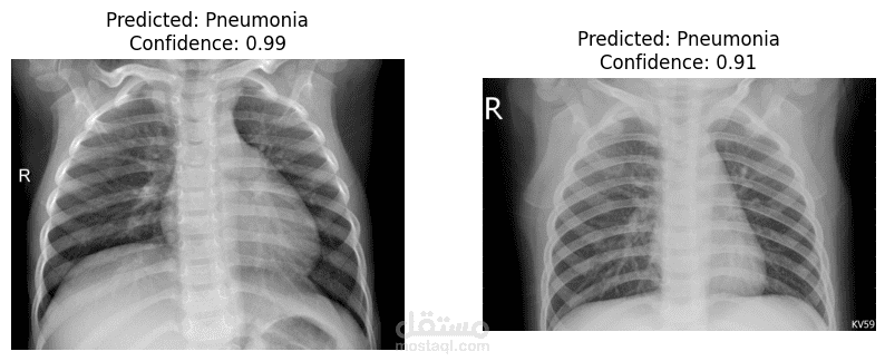 تطبيق ذكاء اصطناعي لتشخيص الالتهاب الرئوي من صور الأشعة