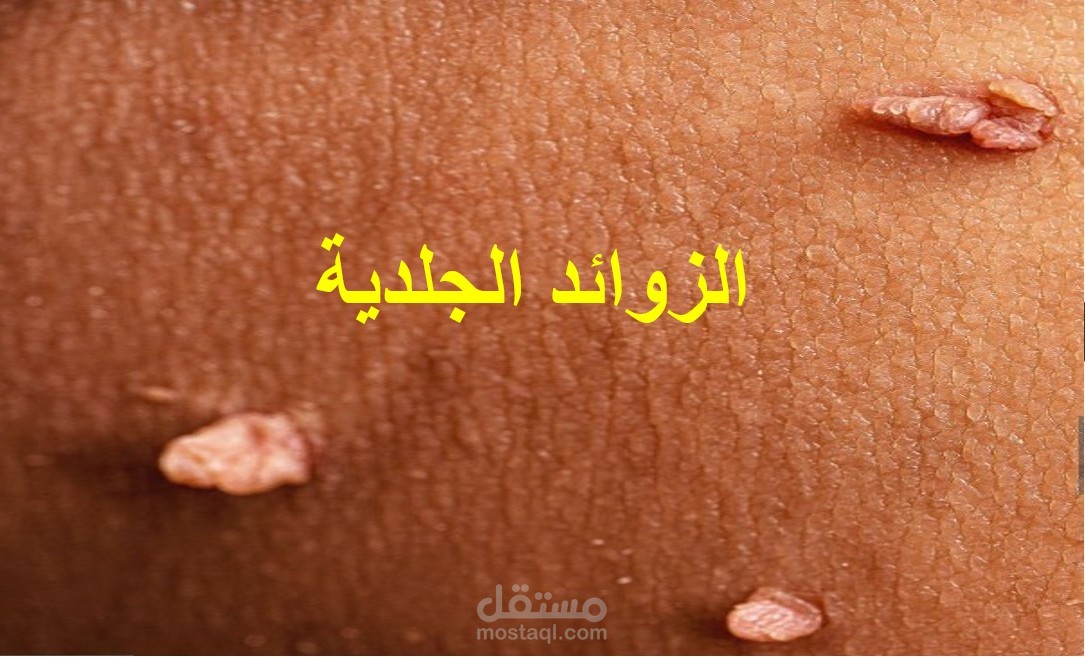 تجميع صور وكتابة نص عليها لموضوع عن " الزوائد الجلدية" وذلك لإستخدامهم لاحقا" في صناعة محتوى (فيديو).