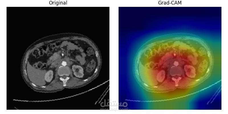 Kidney Cancer Classification Using Deep + Machine Learning