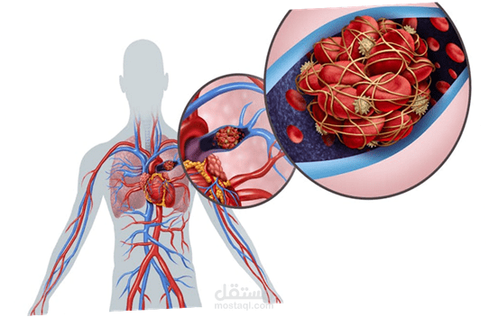 تحليل مقال علمي في مجال قانون الطب باللغتين الفرنسية و الانجليزية تحت عنوان "الفشل في تشخيص الانسداد الرئوي وعدم كفاية المراقبة وتحديد المسؤوليات "
