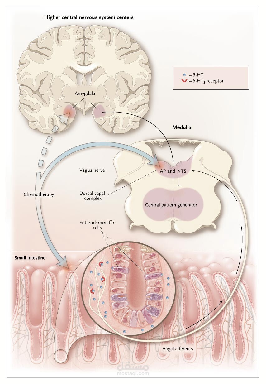 The treatment Chemotherapy induced nausea and vomiting