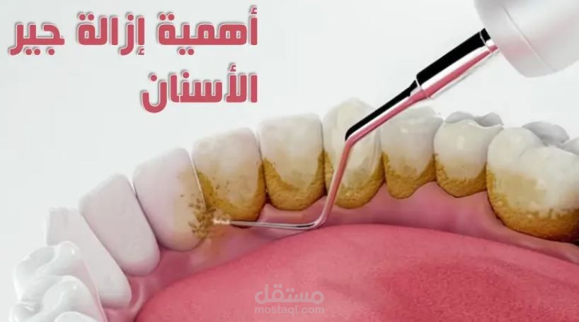 أهمية إزالة جير الأسنان