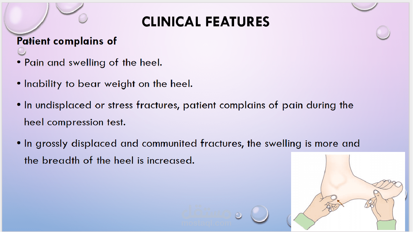 Foot Fracture