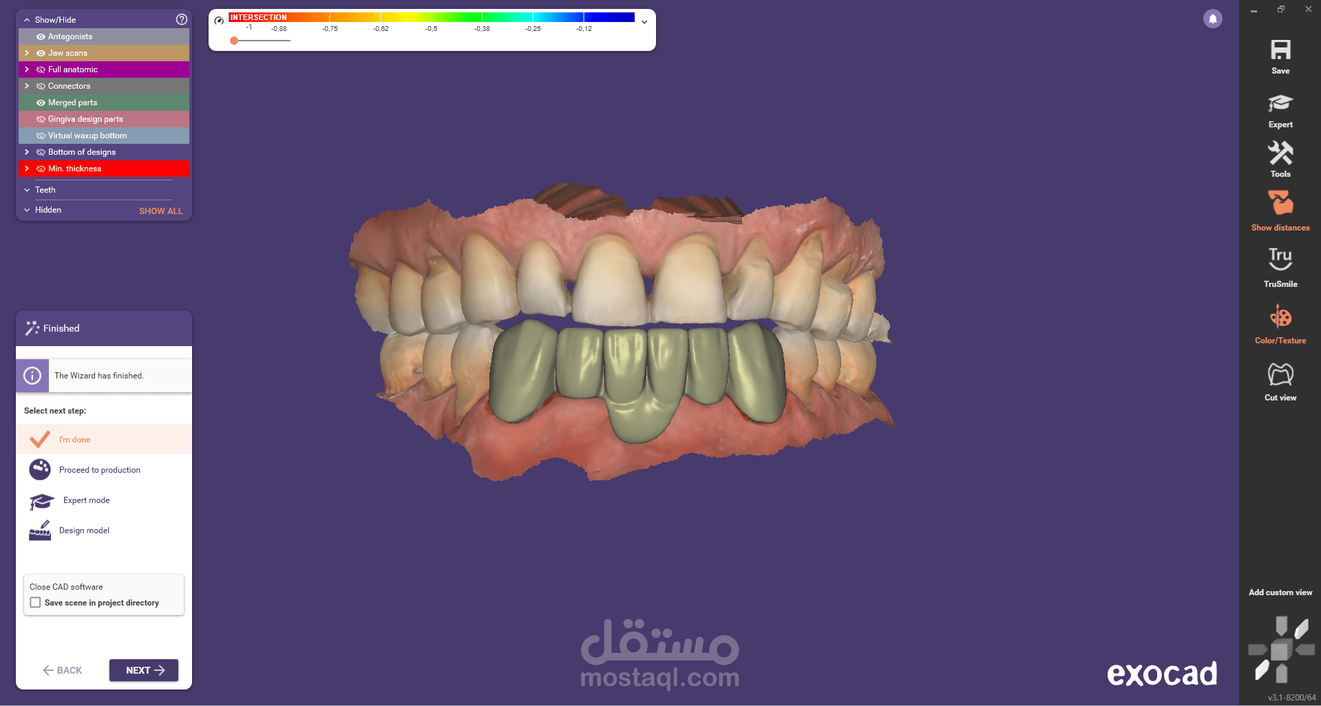 ZIRCON BRIDGE WITH VIRTUAL GINGIVA
