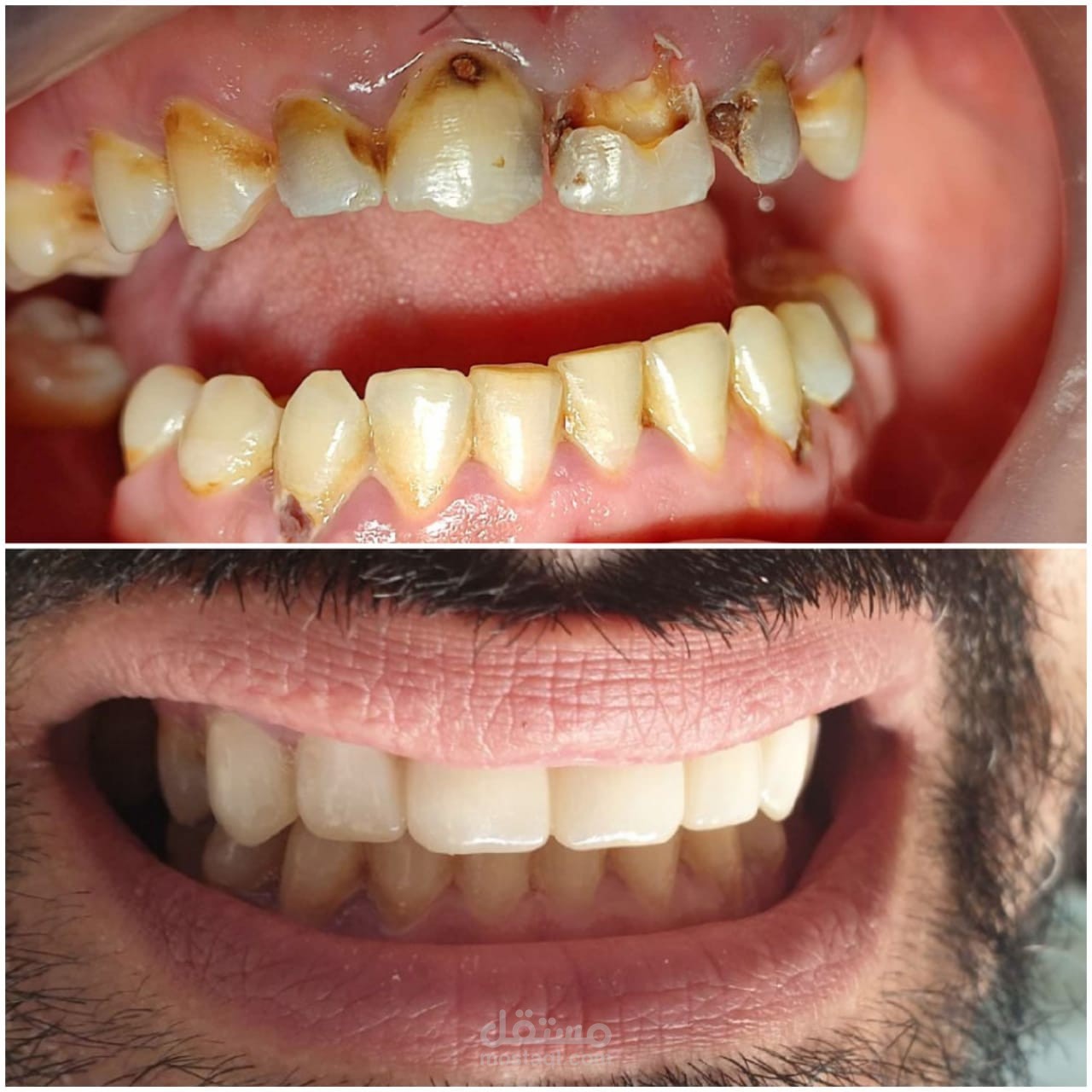 ANTERIOR ZIRCON BRIDGE