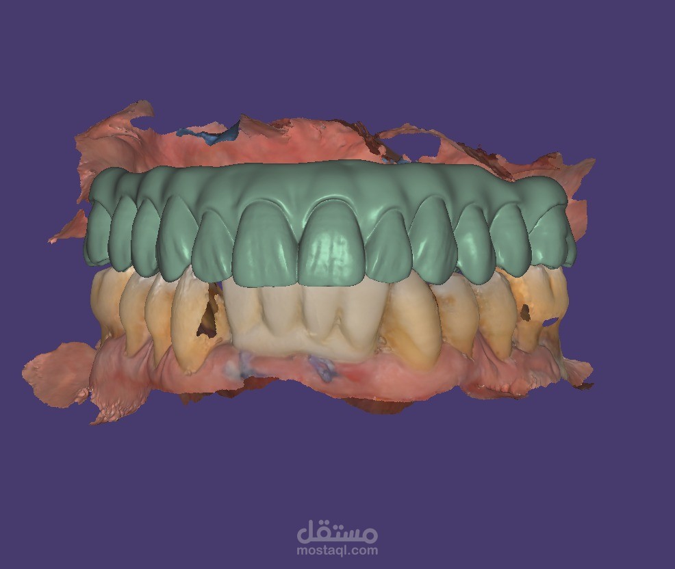 ALL ON 6 SUPERIOR ZIRCON BRIDGE