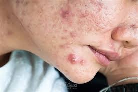 Acne: Causes, Symptoms, Treatment, and Prevention.