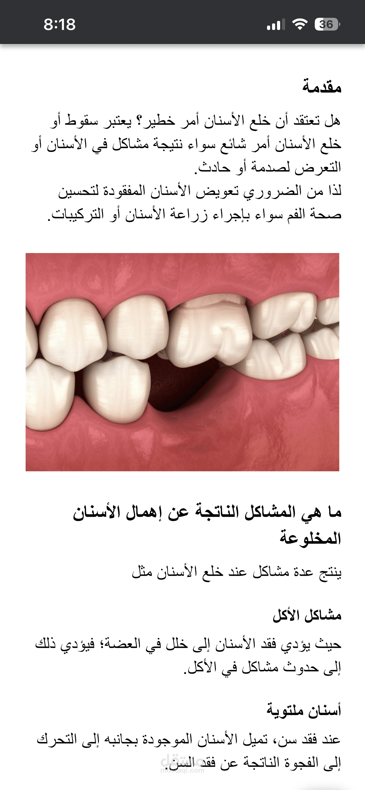 طرق تعويض الأسنان المفقودة