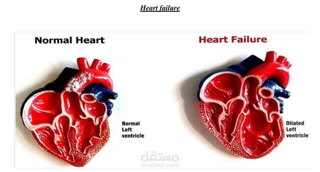 Medical assignment about heart failure