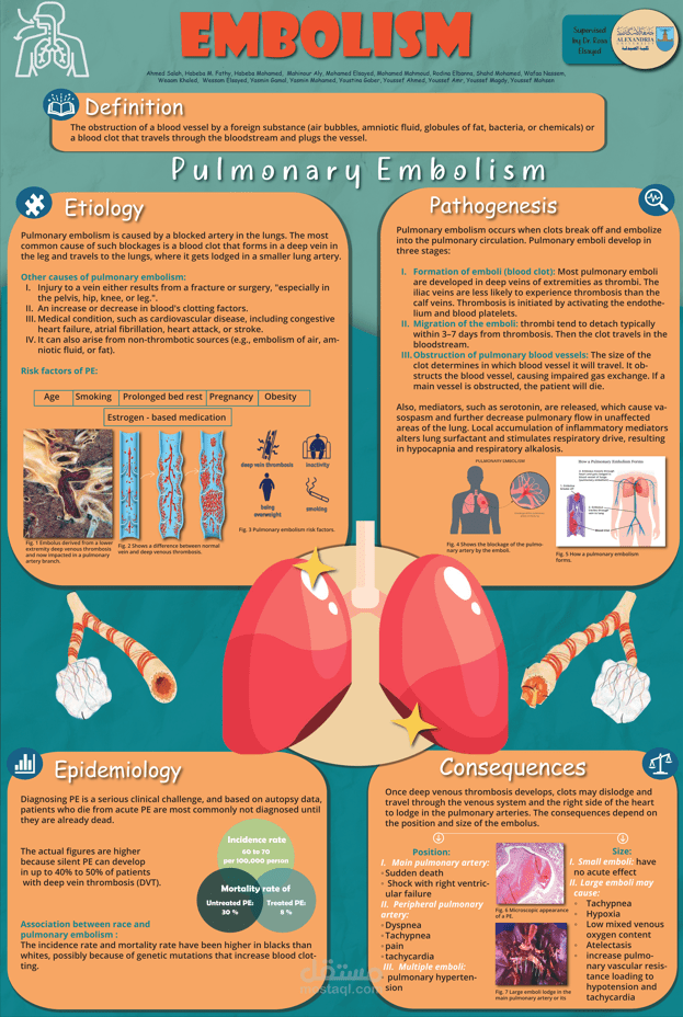 تصميم بوستر إنفوجرافيك تعليمي عن الانسداد الرئوي (Pulmonary Embolism)