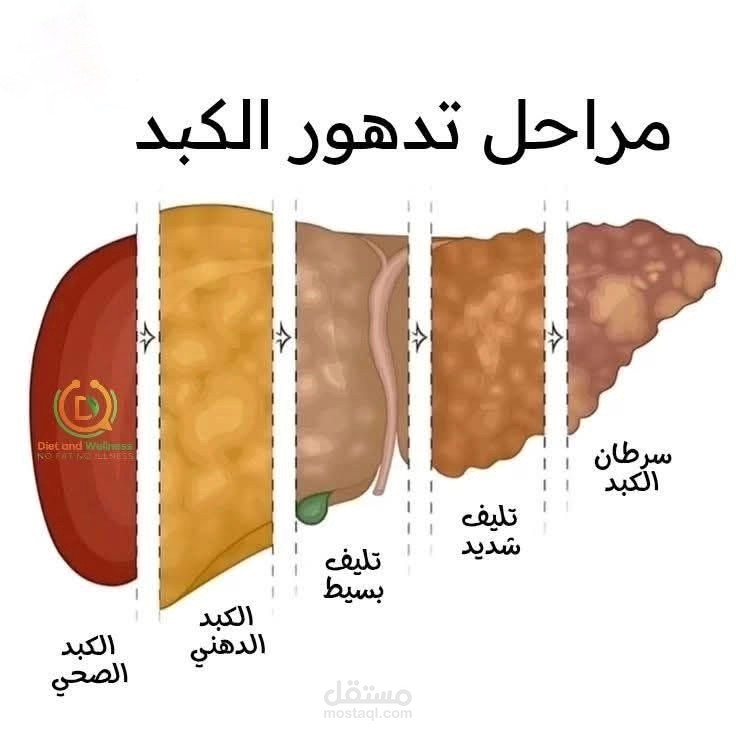 ازاى تحسن من صحة كبدك وتتجنب الكبد الدهنى