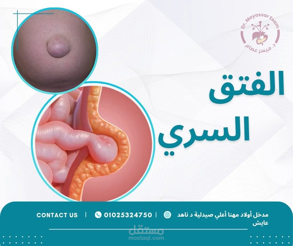 الفتق السري