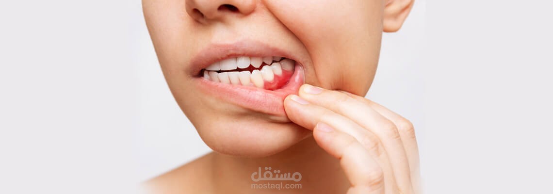 التهاب اللثه(الأسباب،الأنواع،العلاج)