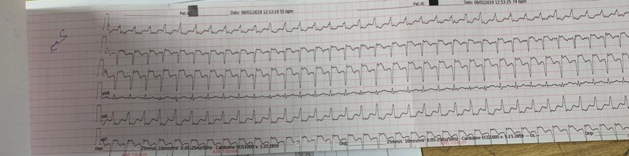 تفسير رسم قلب جلطة بالقلب