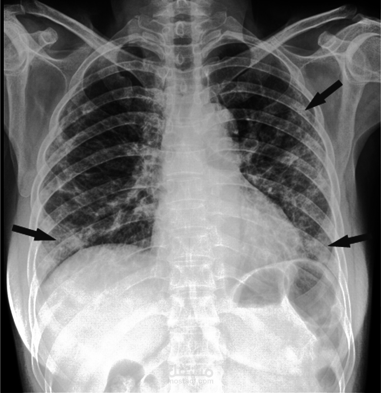مشروع للتعرف على الاصابة بفيرس كورونا باستخدام التعلم العميق