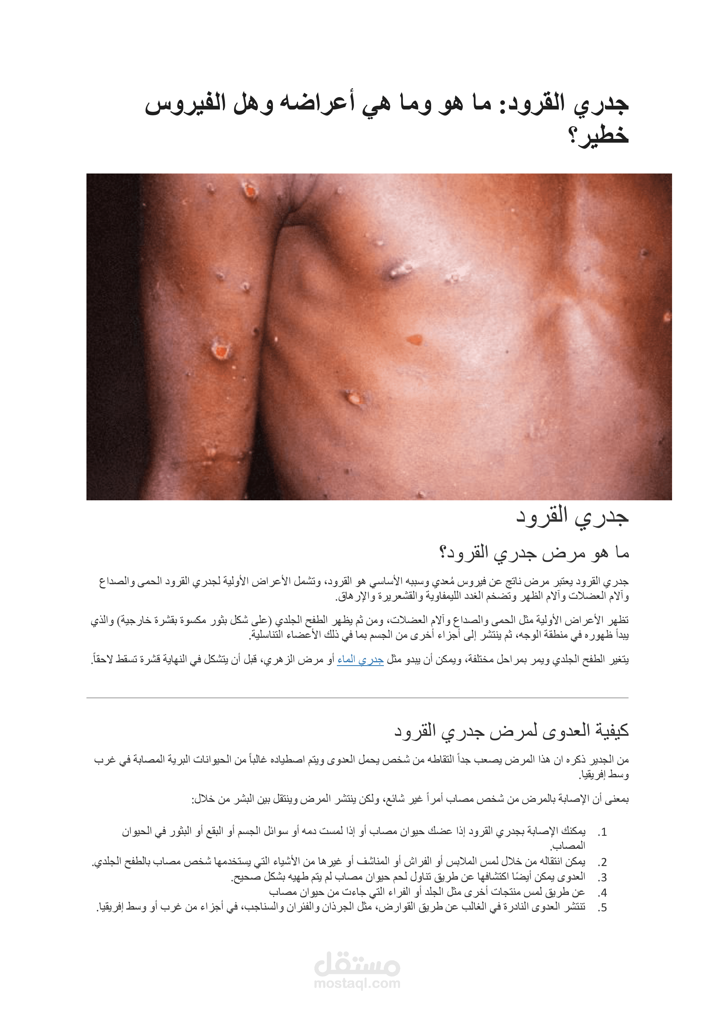 Monkey Pox - جدري القرود