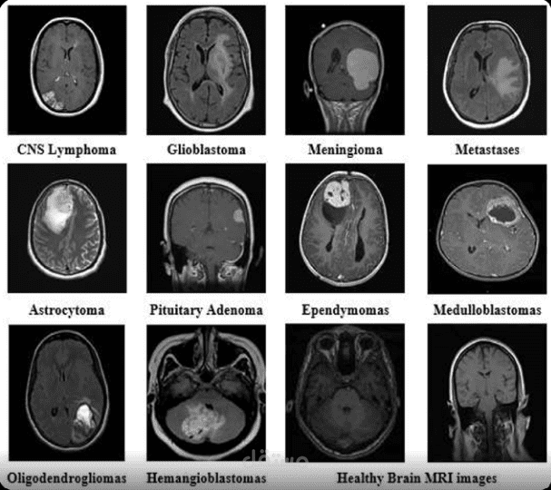تصنيف أورام الدماغ بالذكاء الاصطناعي من صور MRI
