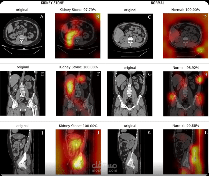 كشف حصى الكلى بالذكاء الاصطناعي من الصور الطبية