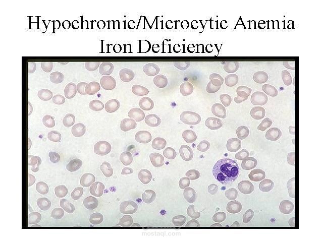 Microcytic Anemia Case Study – CBC Report Interpretation