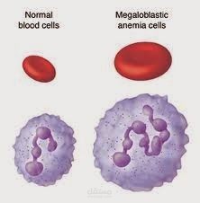 Macrocytic anemia article