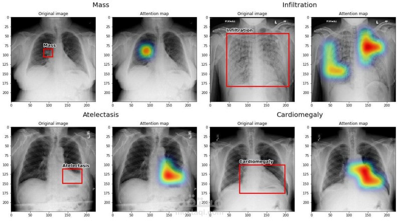 ظام كشف وتصنيف الأمراض في الأشعة الطبية (طبية - Chest X-Ray Classification + Segmentation)