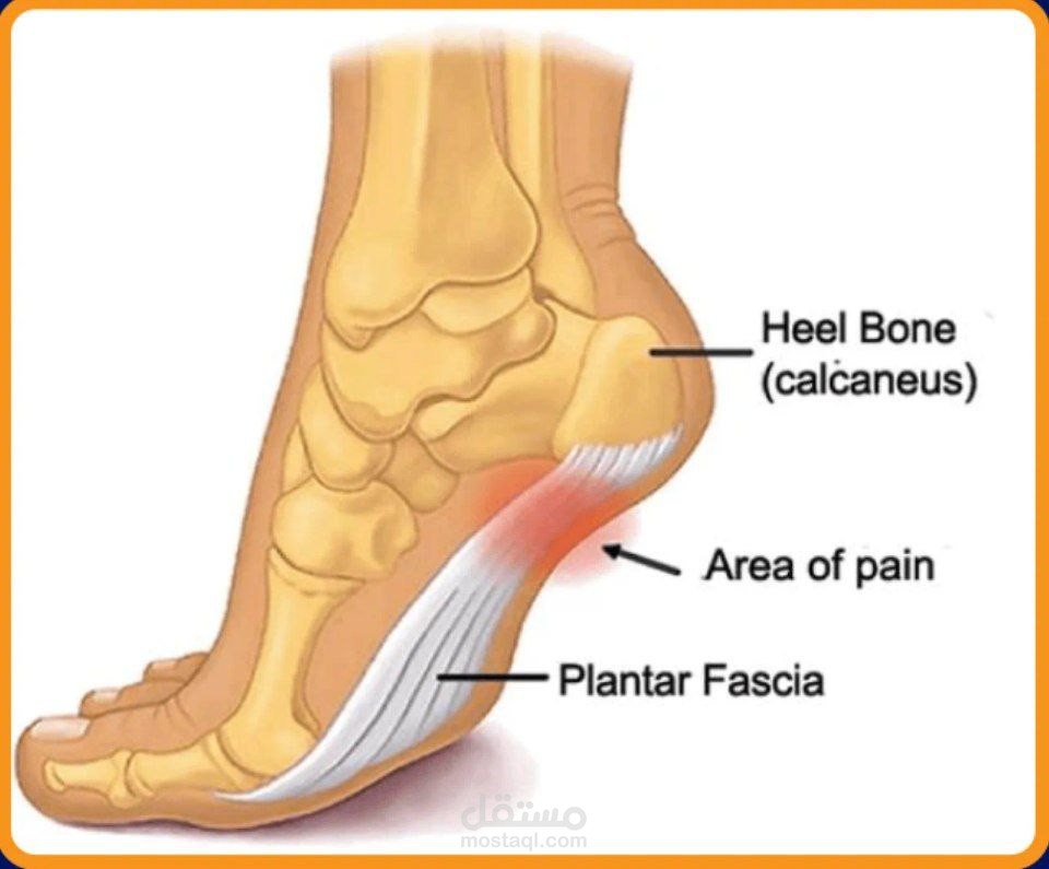 من الألم إلى التعافي: كيف تتعامل مع إلتهاب اللفافة الأخمصية او ما تعرف باسم )(Plantar fascities؟