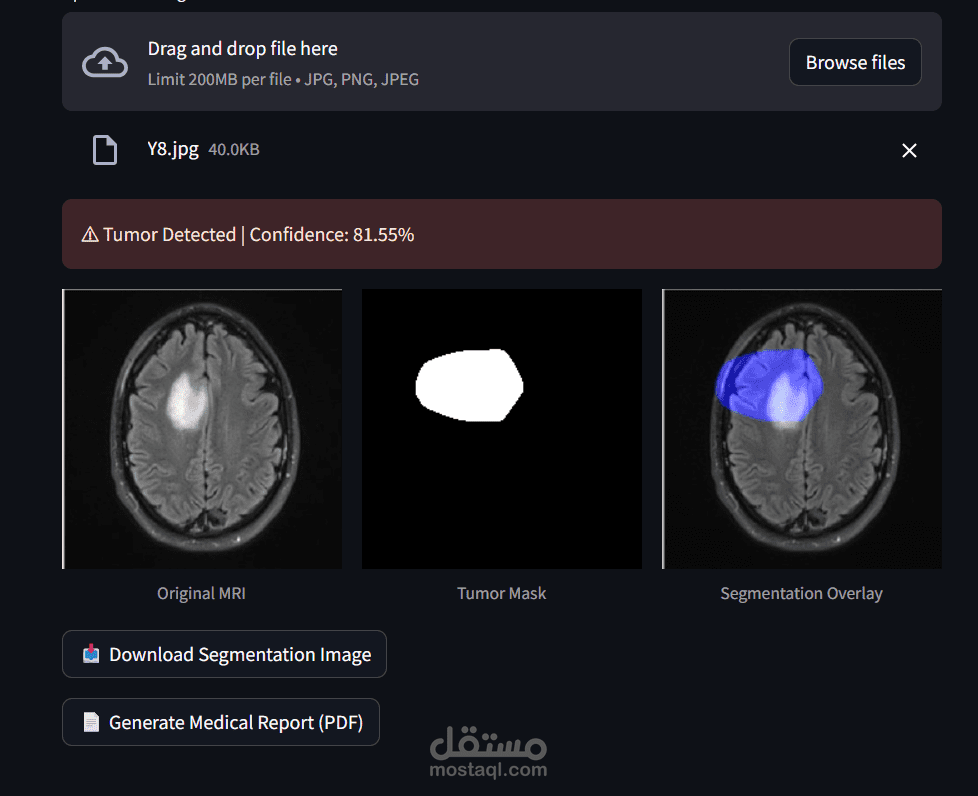 AI-Based Brain Tumor Detection using Deep Learning