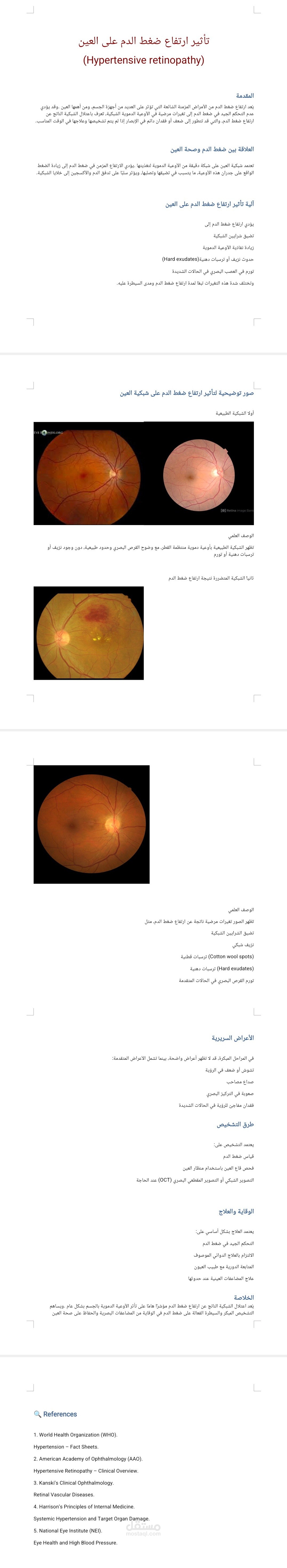 بحث عن تأثير ارتفاع ضغط الدم على العين