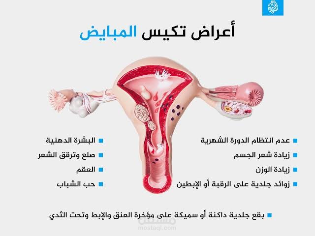 متلازمة تكيس المبايض
