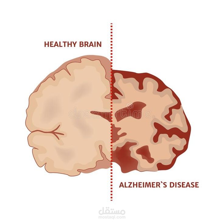 "فهم الزهايمر المبكر: دليل طبي مبسط