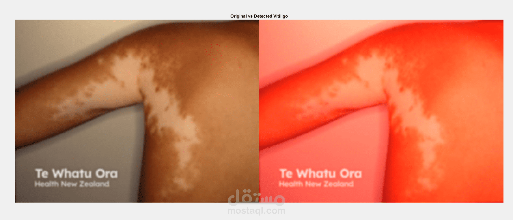 Vitiligo Detection using MATLAB