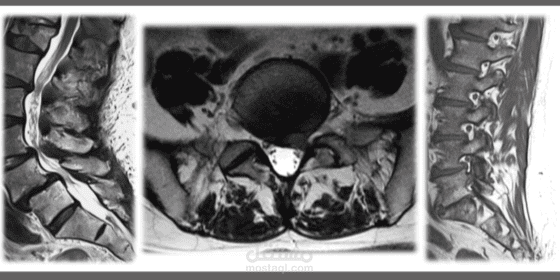 تصميم نماذج ذكاء اصطناعي لتشخيص حالات العمود الفقري من صور الرنين المغناطيسي
