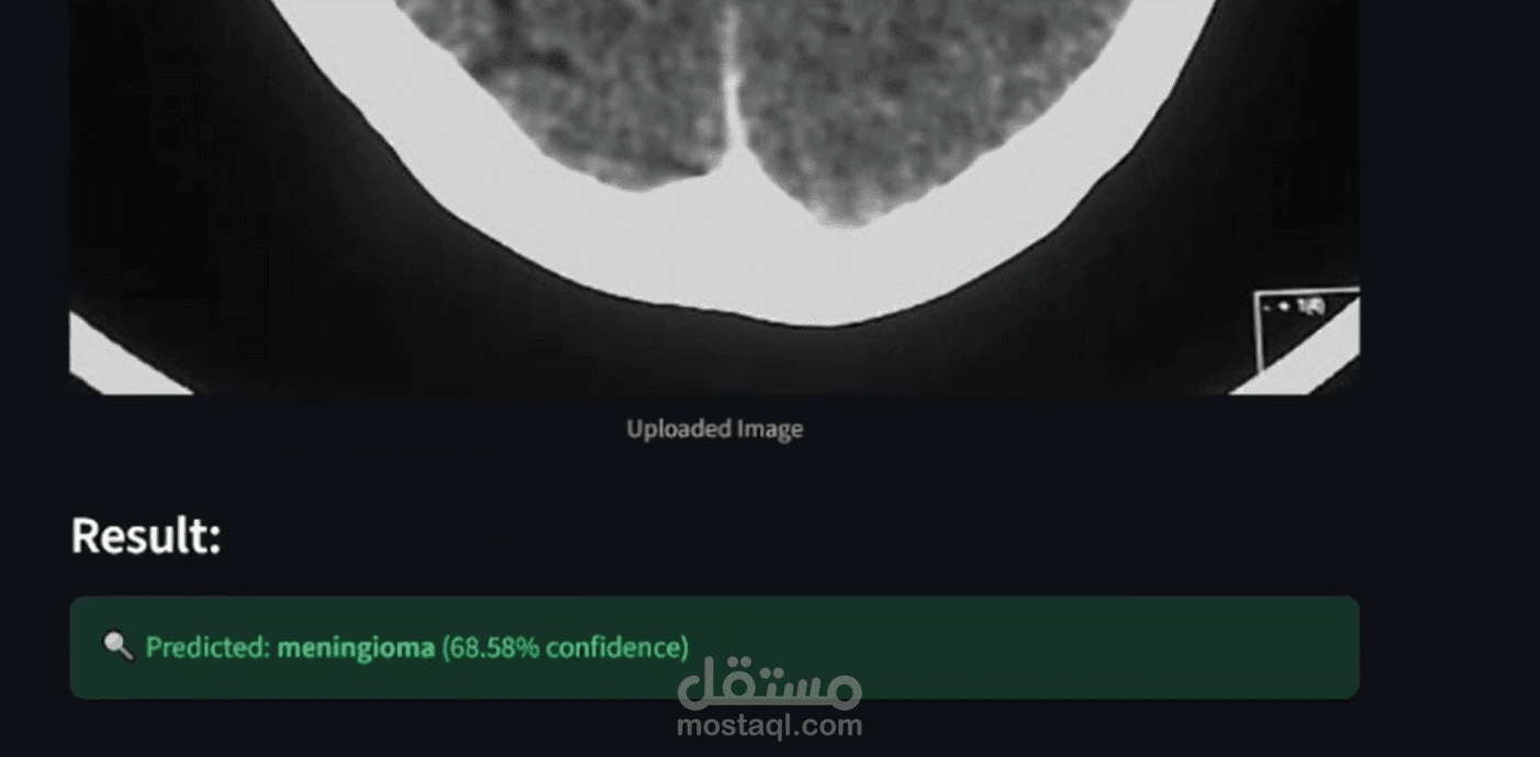 brain tumor detection