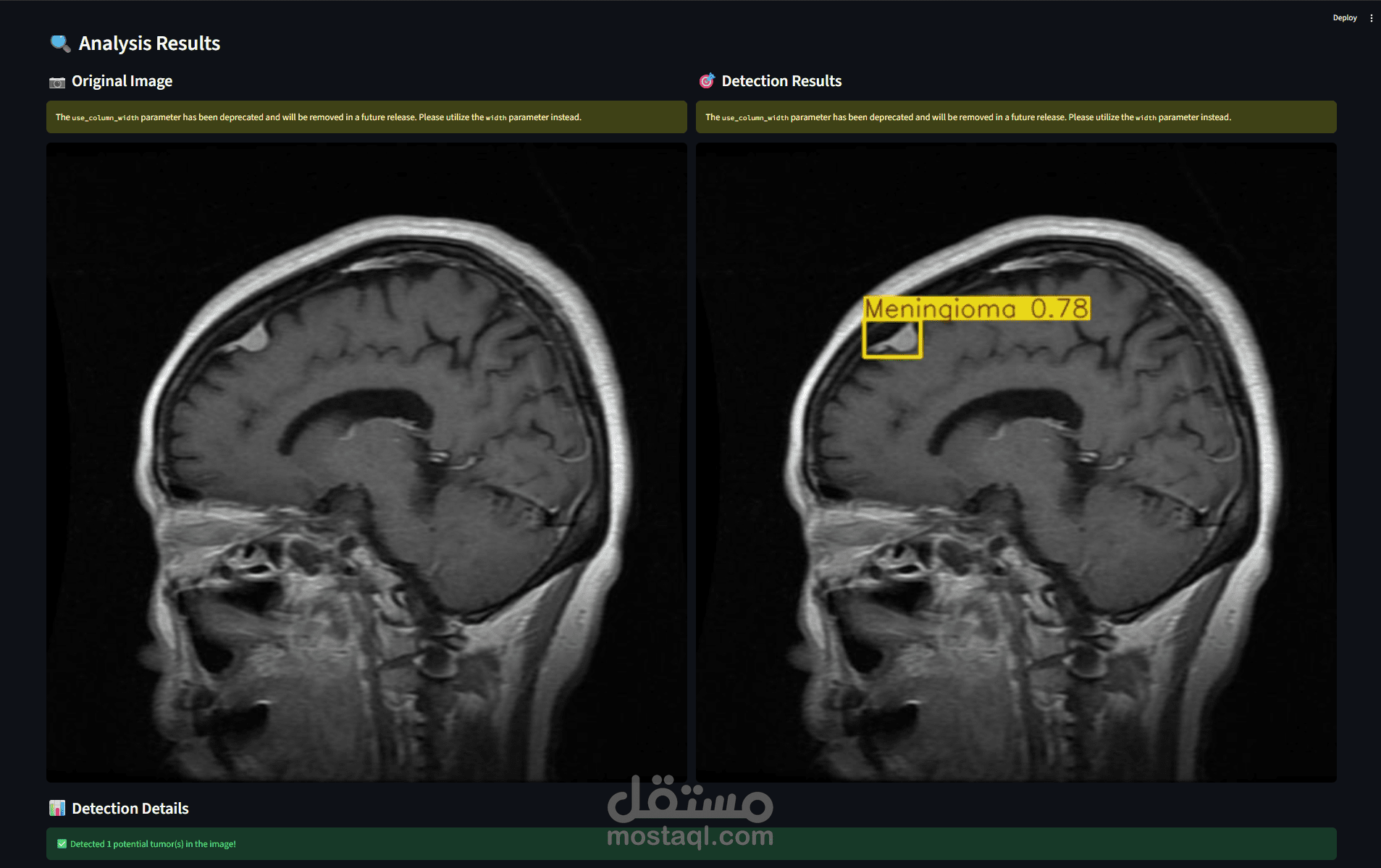MRI Brain Tumor Detection
