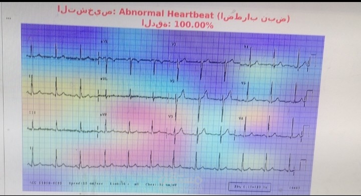 بناء وتطوير نموذج تعلم عميق (Deep Learning) متقدم لتحليل صور تخطيط كهربية القلب (ECG) واكتشاف الاضطرابات القلبية