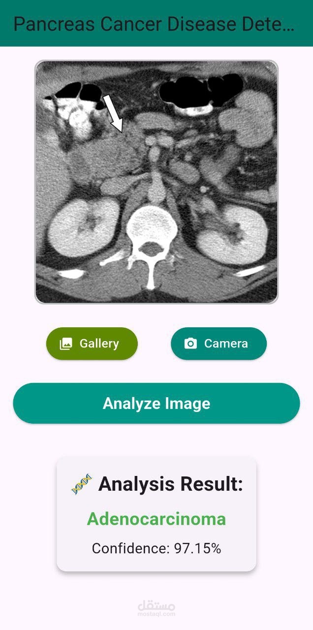 Pancreas Cancer Disease Detection Using CNN