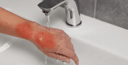 Comprehensive First Aid Guide for Burns (Bilingual: Arabic & English)