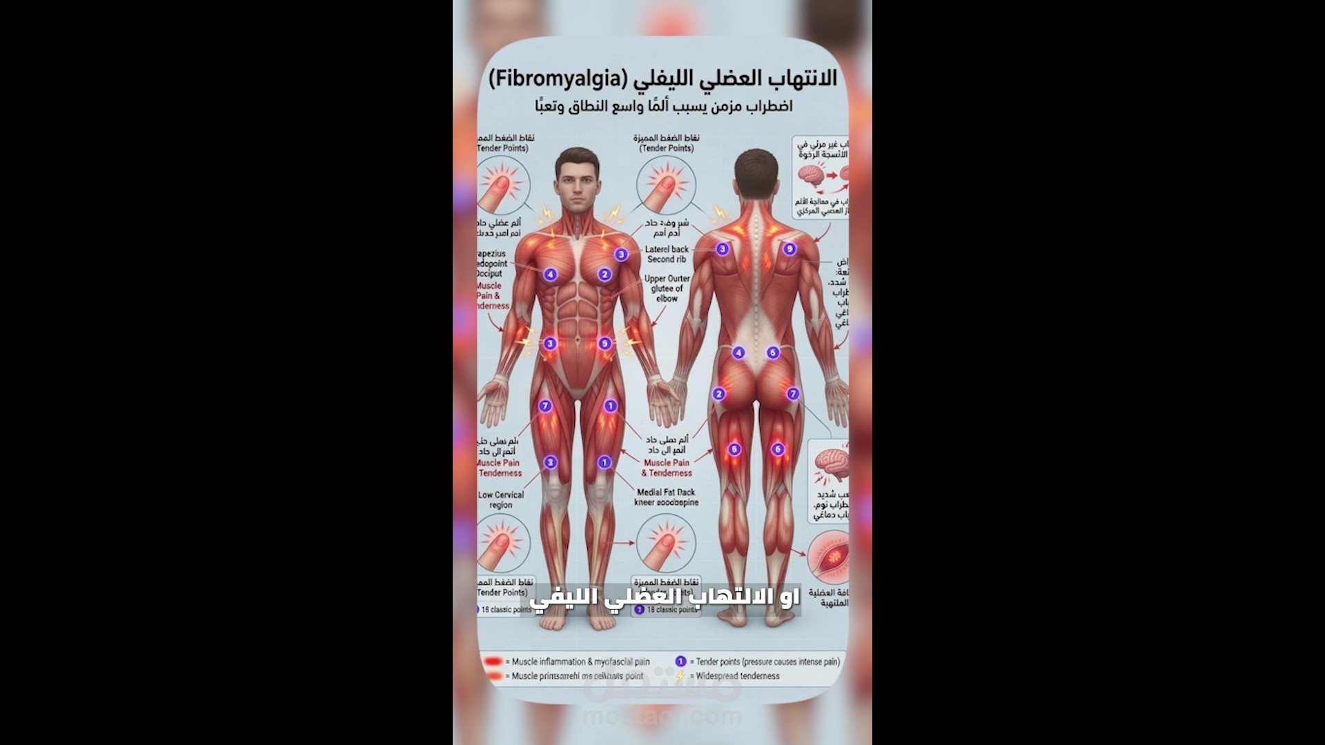 Fibromyalgia