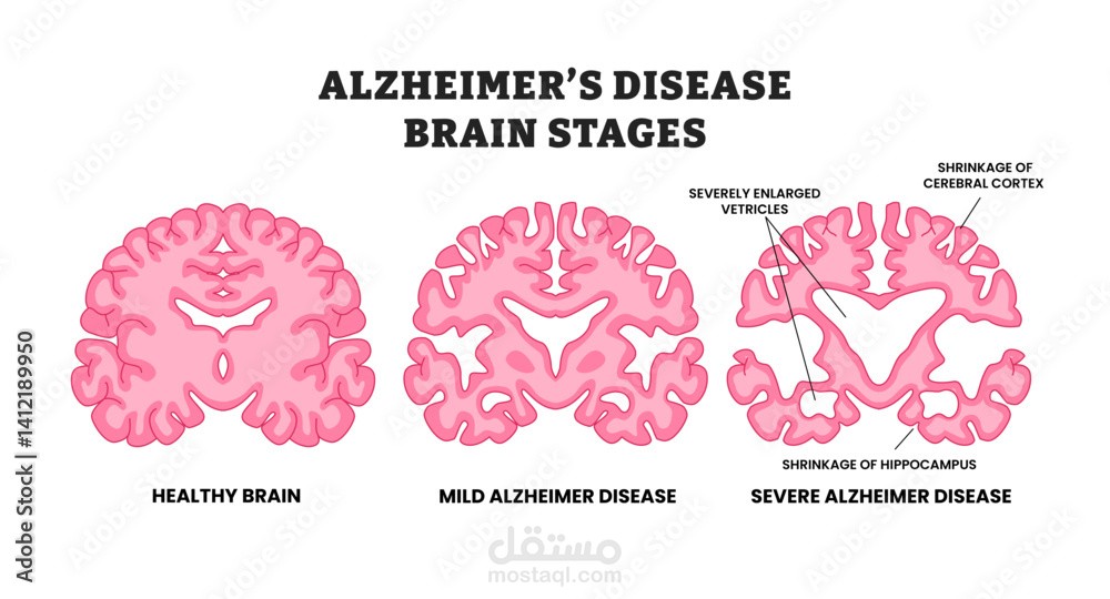 التنبؤ بمرض الزهايمر باستخدام تعلم الآلة (Alzheimer Disease Prediction using Machine Learning)