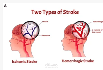 Healthcare Stroke Data Analysis