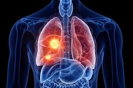 lung cancer detection