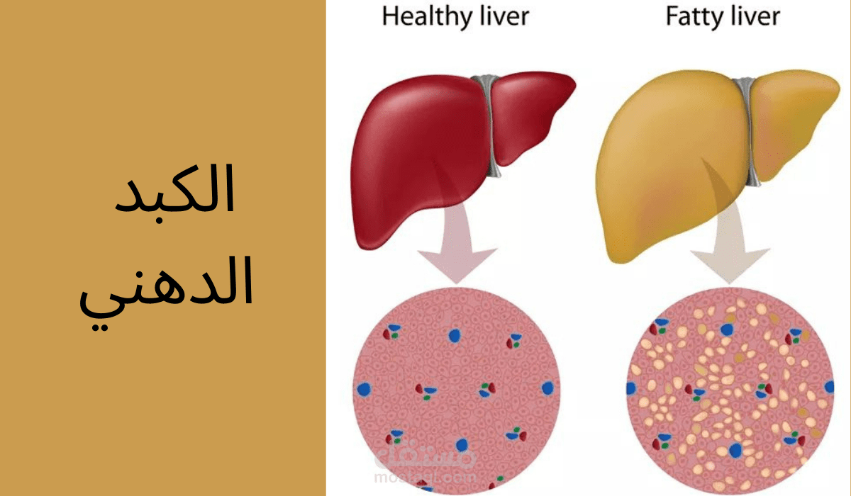 مقال عن مشروبات لعلاج الكبد الدهني