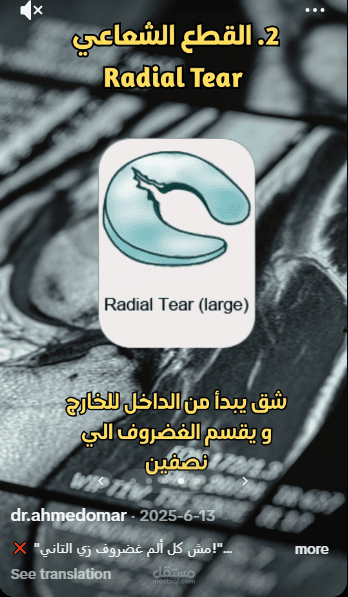 مجموعه صور لنصيحة طبية عن نوع قطع الغضروف الداخلي