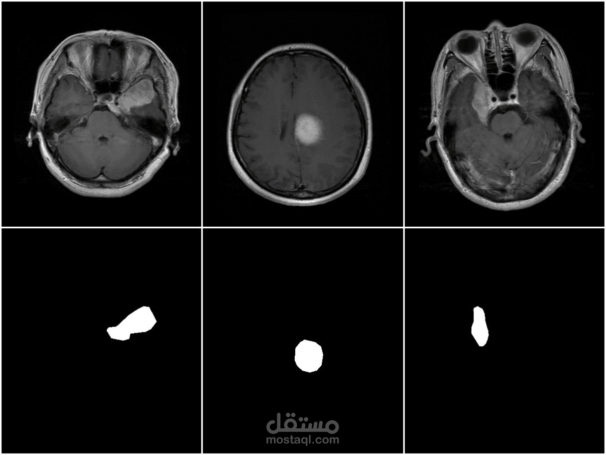 زيادة بيانات أورام الدماغ اصطناعياً | Brain Tumor Data Augmentation