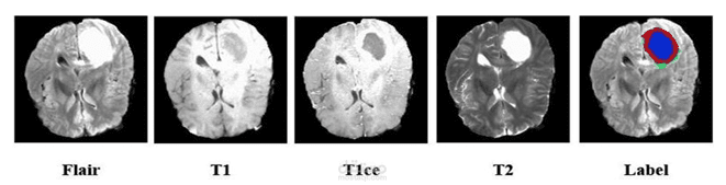 A systematic evaluation of pre-trained encoder architectures for multimodal brain tumor segmentation using U-Net-based architectures