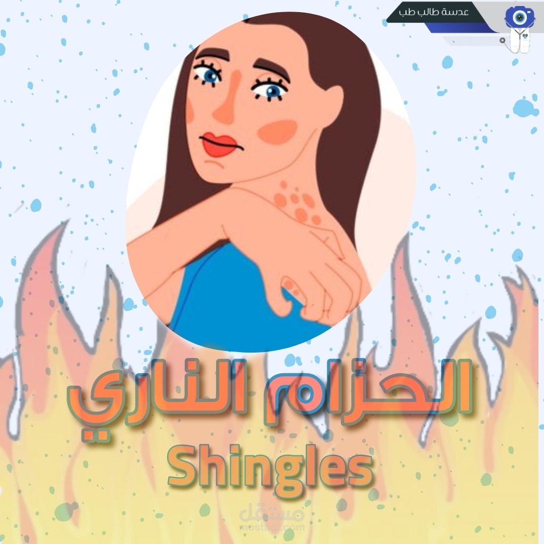 تصميم إنفوغرافيك طبي حول مرض الحزام الناري (Shingles)