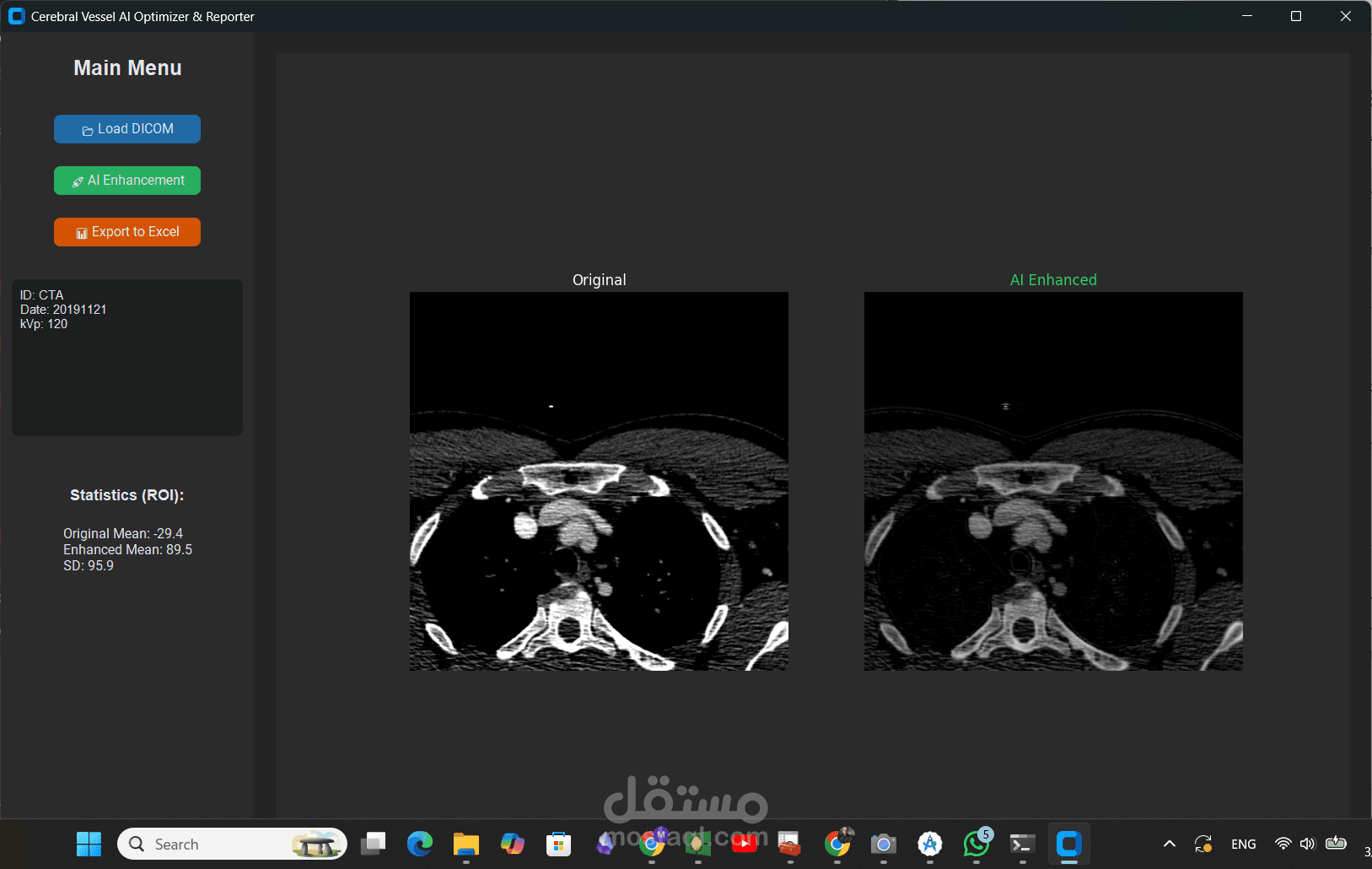برنامج ذكي لتحسين وإبراز الشرايين والأوعية الدموية في الأشعة المقطعية بالصبغة (Cerebral Vessel AI Optimizer & Reporter)