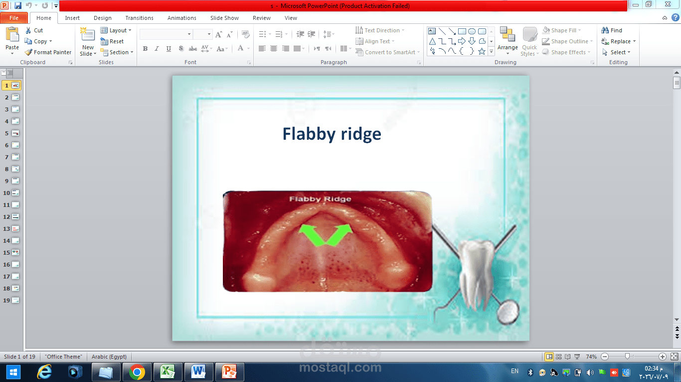 presentation about flabby ridge